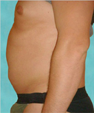Patient # 12526 Before Photo # 1
